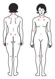 fibromyalgie pijn tenderpoints